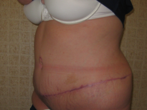 Mommy Makeover after at Port City Plastic Surgery - Charleston in Charleston, SC