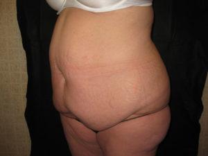 Mommy Makeover before at Port City Plastic Surgery - Charleston in Charleston, SC