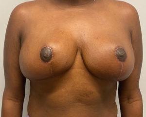 Breast Reduction after at Port City Plastic Surgery - Charleston in Charleston, SC