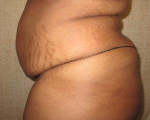 Mommy Makeover before at Port City Plastic Surgery - Charleston in Charleston, SC