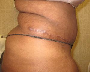 Mommy Makeover after at Port City Plastic Surgery - Charleston in Charleston, SC