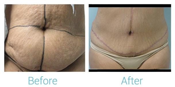 Brent Birely, MD tummy tuck result — Lutherville, MD