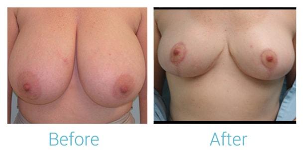 Brent Birely, MD breast lift result — Lutherville, MD