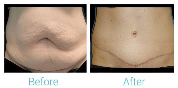 Brent Birely, MD tummy tuck result — Lutherville, MD