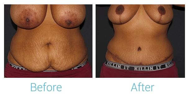 Brent Birely, MD mommy makeover result — Lutherville, MD