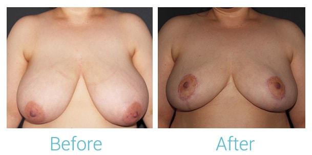 Brent Birely, MD breast lift result — Lutherville, MD