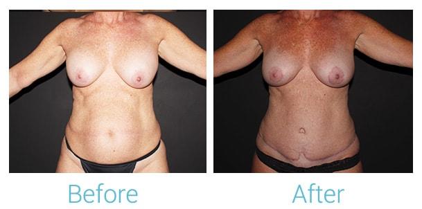 Brent Birely, MD mommy makeover result — Lutherville, MD