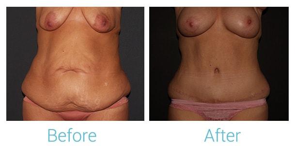 Brent Birely, MD mommy makeover result — Lutherville, MD