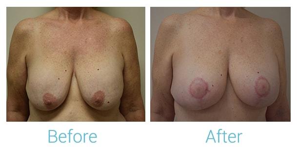 Brent Birely, MD breast lift result — Lutherville, MD