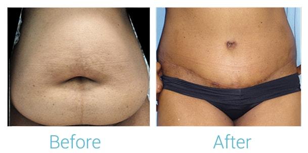Brent Birely, MD tummy tuck result — Lutherville, MD
