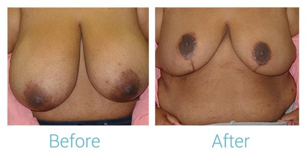 Brent Birely, MD breast lift result — Lutherville, MD