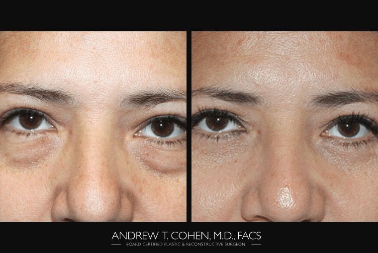 Andrew T. Cohen, MD eyelid lift result — Los Angeles, CA