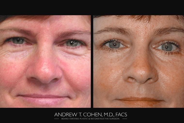 Andrew T. Cohen, MD eyelid lift result — Los Angeles, CA