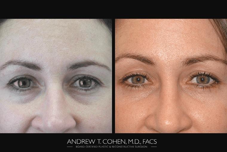Andrew T. Cohen, MD eyelid lift result — Los Angeles, CA