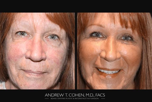 Facelift result at Andrew T. Cohen, MD in Los Angeles, CA