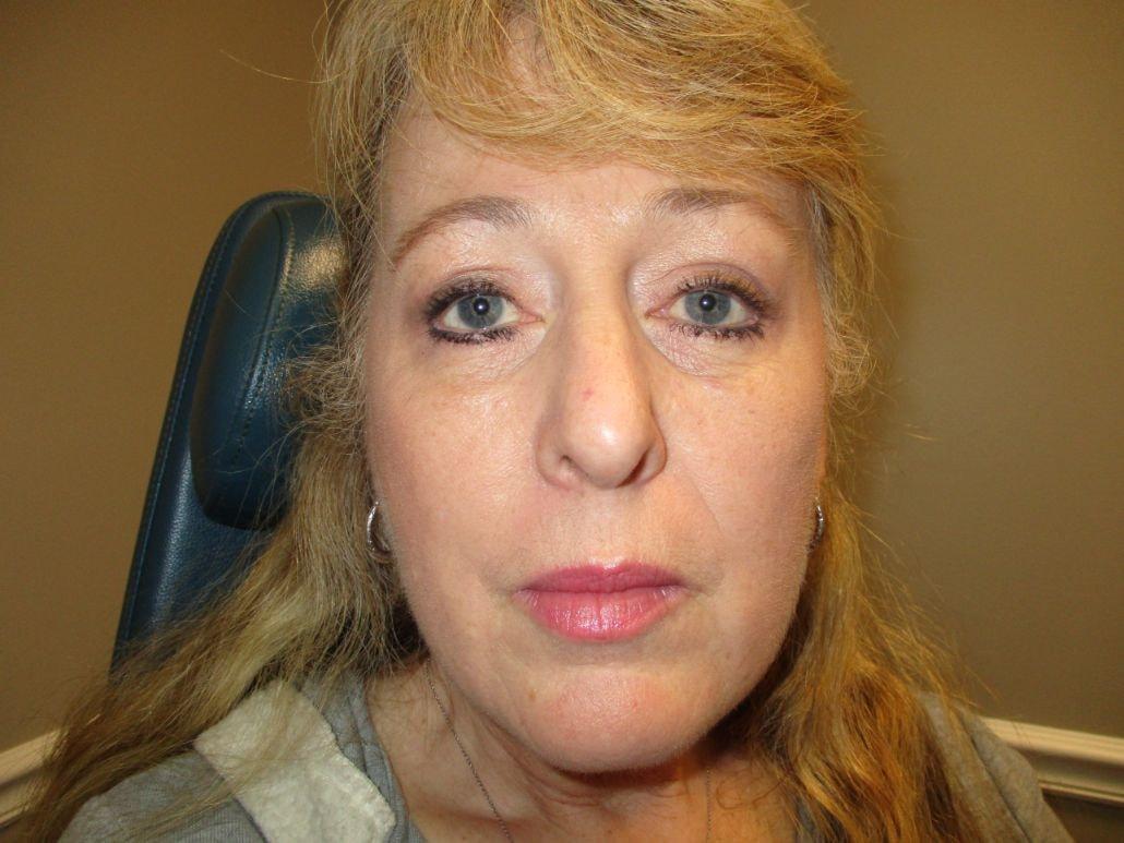 Oculofacial Plastic Surgeons Of Georgia eyelid lift after — Suwanee, GA