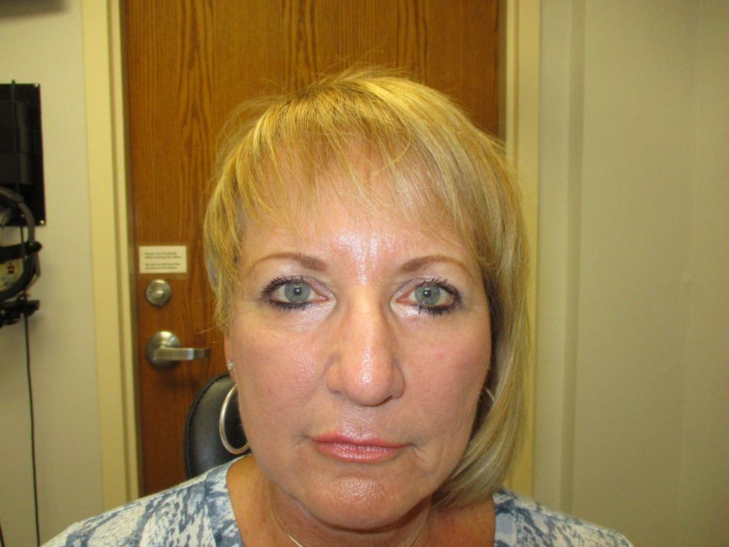 Oculofacial Plastic Surgeons Of Georgia eyelid lift after — Suwanee, GA