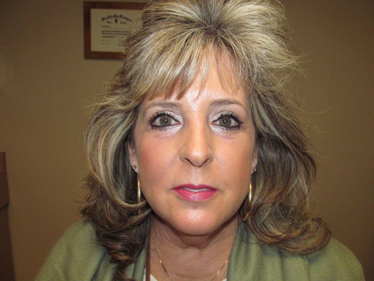 Oculofacial Plastic Surgeons Of Georgia eyelid lift after — Suwanee, GA