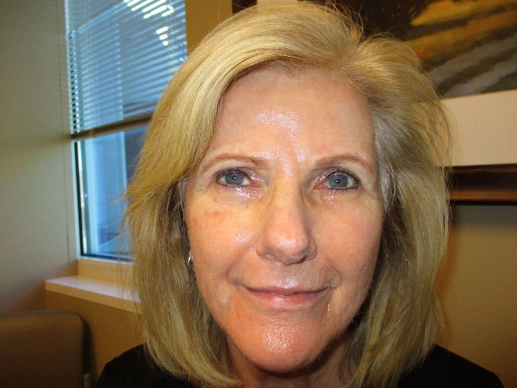Oculofacial Plastic Surgeons Of Georgia eyelid lift after — Suwanee, GA