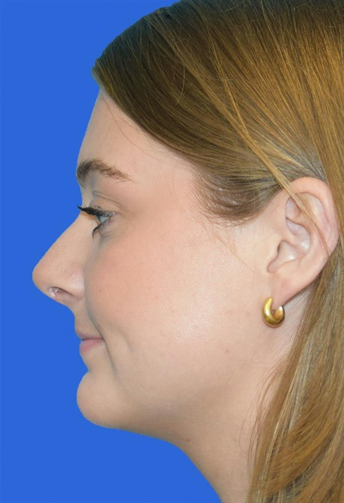 Basu Plastic Surgery rhinoplasty after — Houston, TX