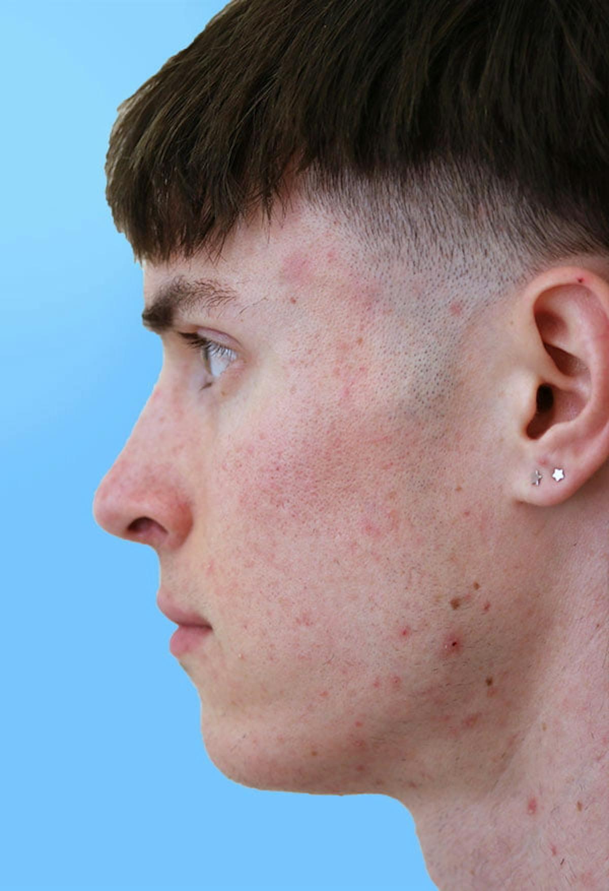 Basu Plastic Surgery rhinoplasty after — Houston, TX