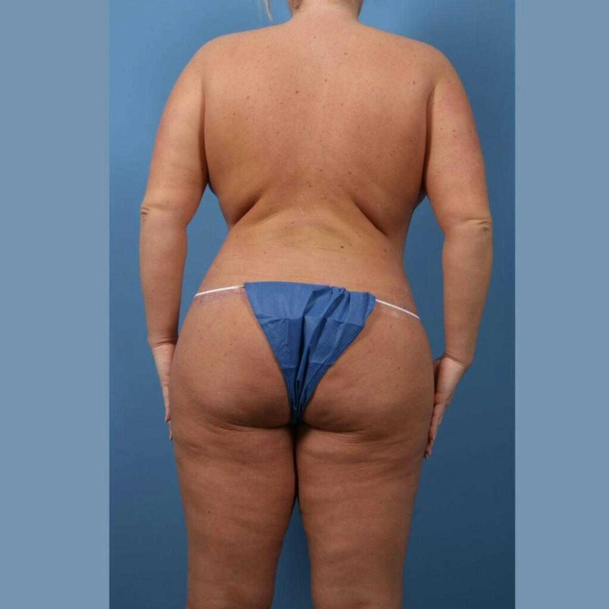 Basu Plastic Surgery bbl after — Houston, TX