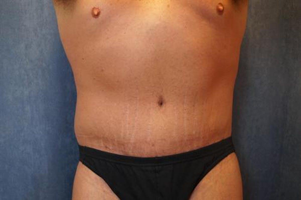 Basu Plastic Surgery body lift after — Houston, TX