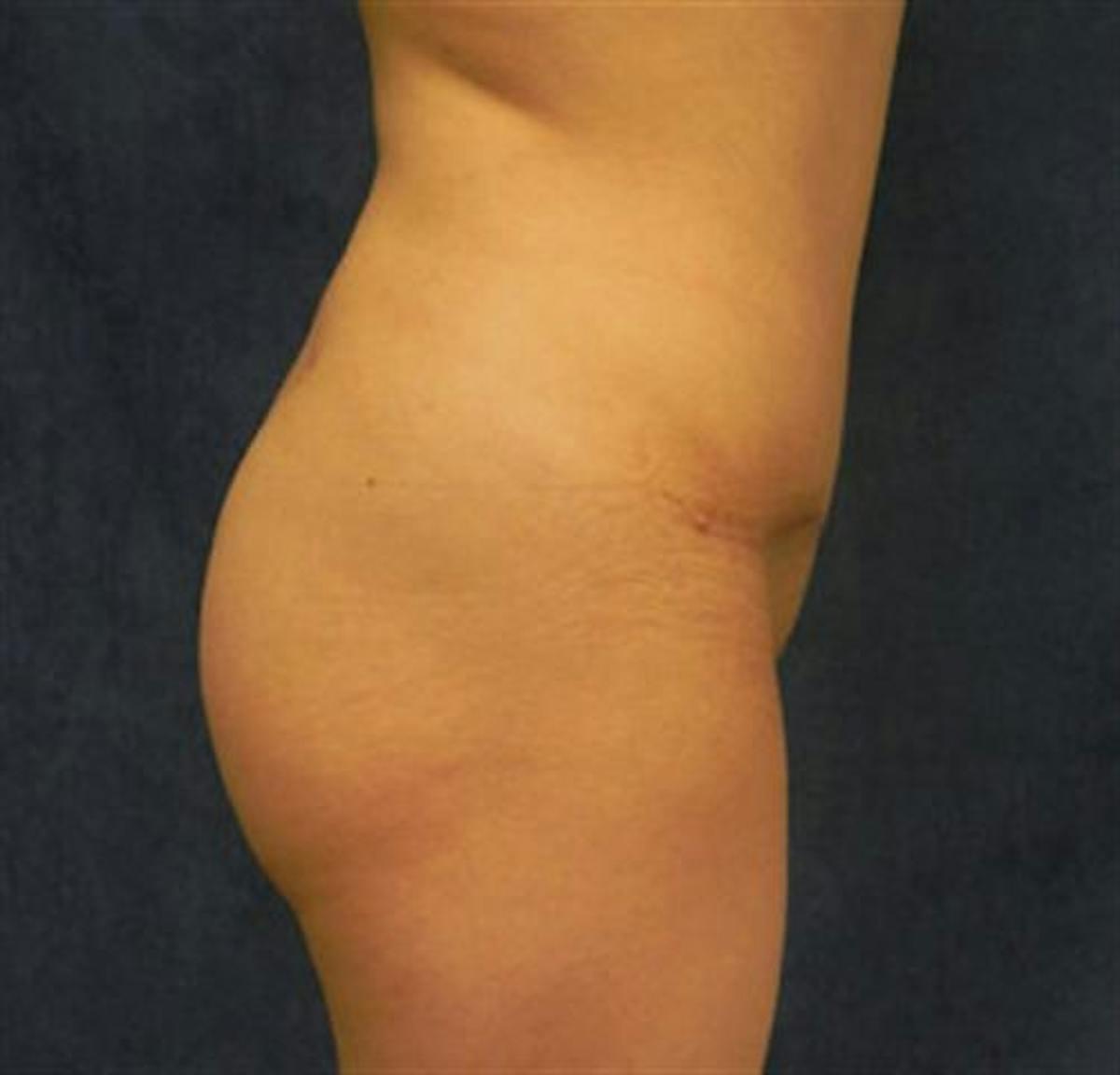 Basu Plastic Surgery bbl after — Houston, TX