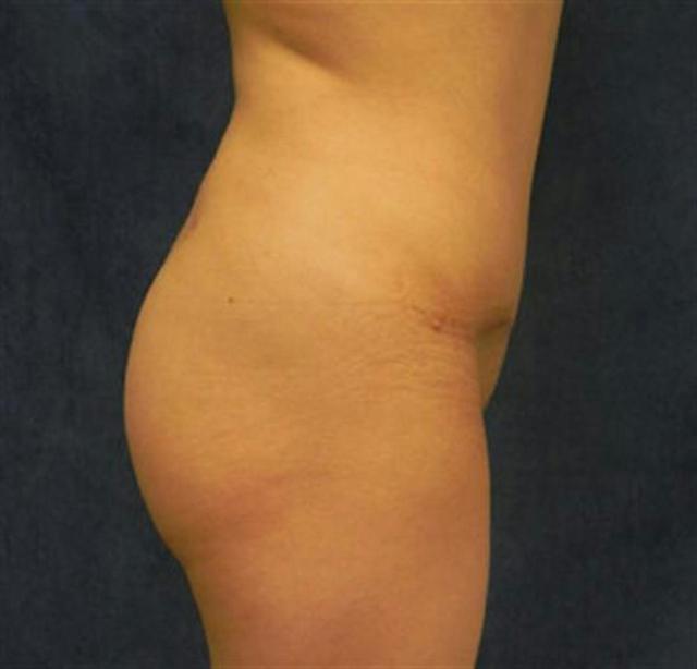 Brazilian Butt Lift after at Basu Plastic Surgery in Houston, TX