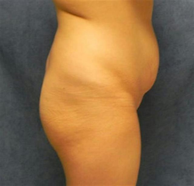 Brazilian Butt Lift before at Basu Plastic Surgery in Houston, TX