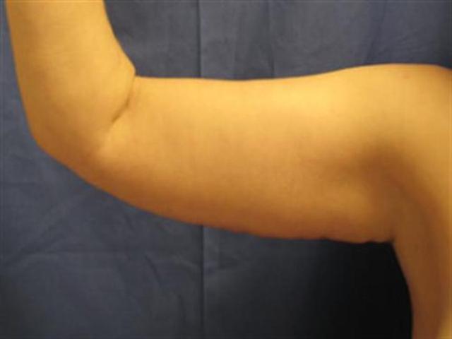 Arm Lift after at Basu Plastic Surgery in Houston, TX