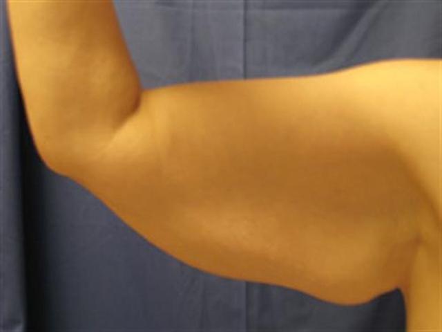 Arm Lift before at Basu Plastic Surgery in Houston, TX