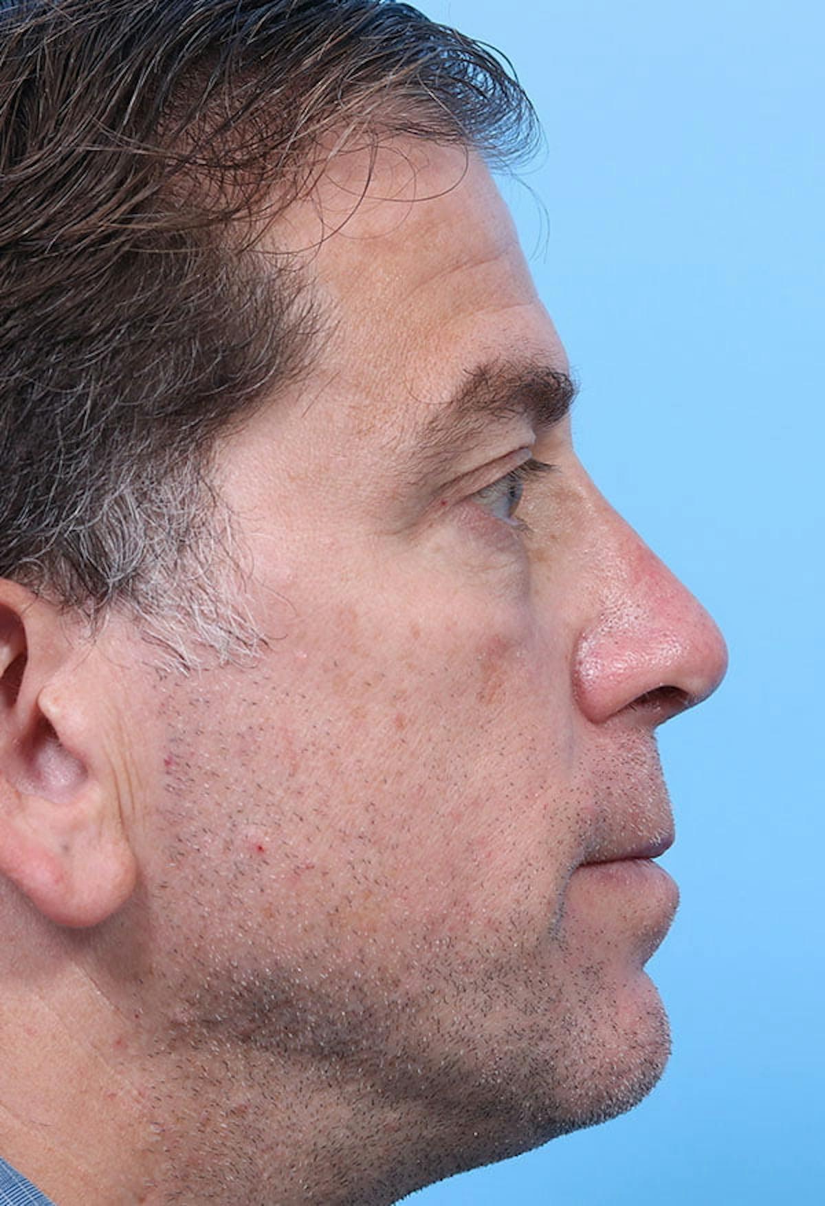 Basu Plastic Surgery rhinoplasty after — Houston, TX