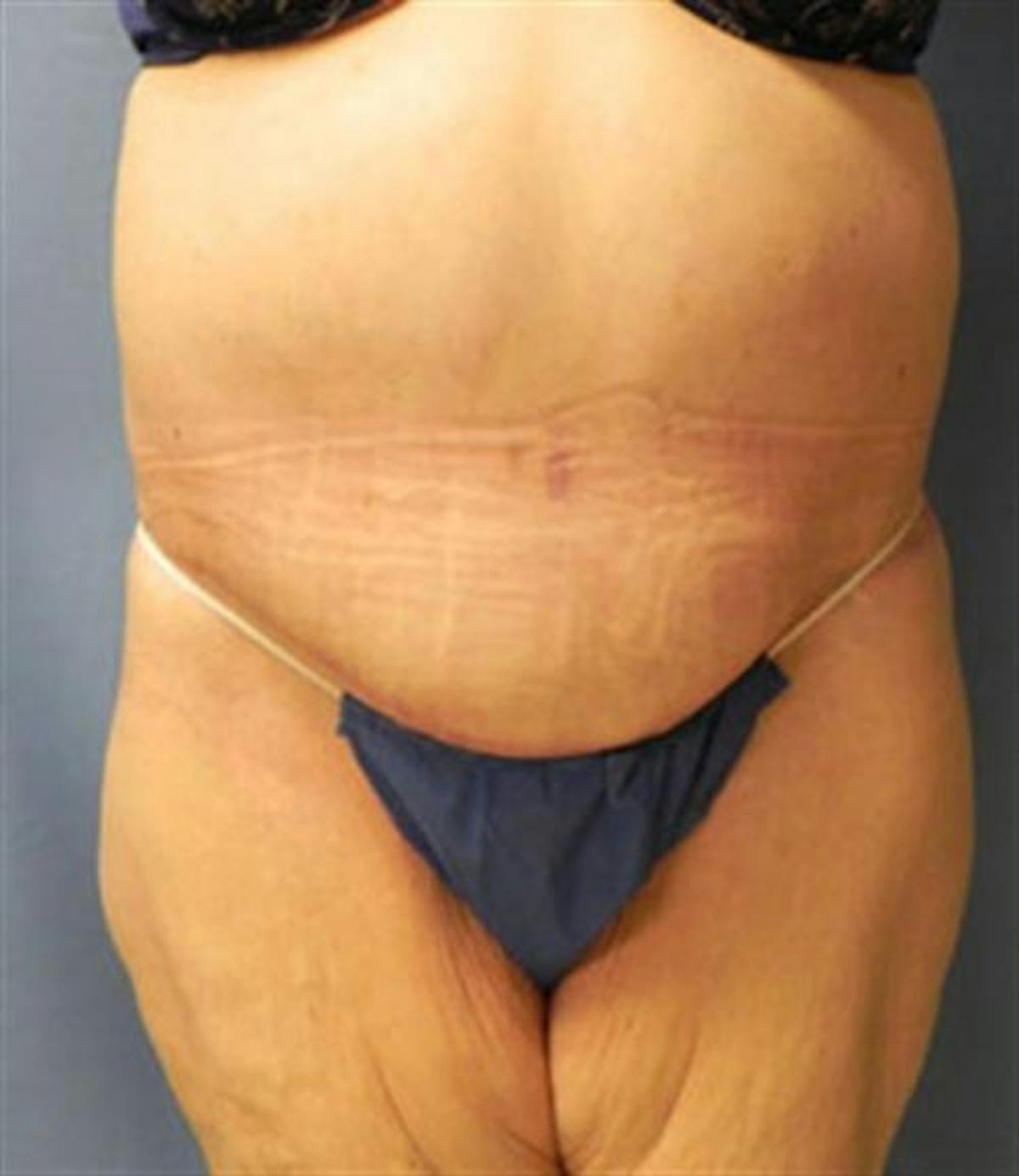 Basu Plastic Surgery body lift after — Houston, TX