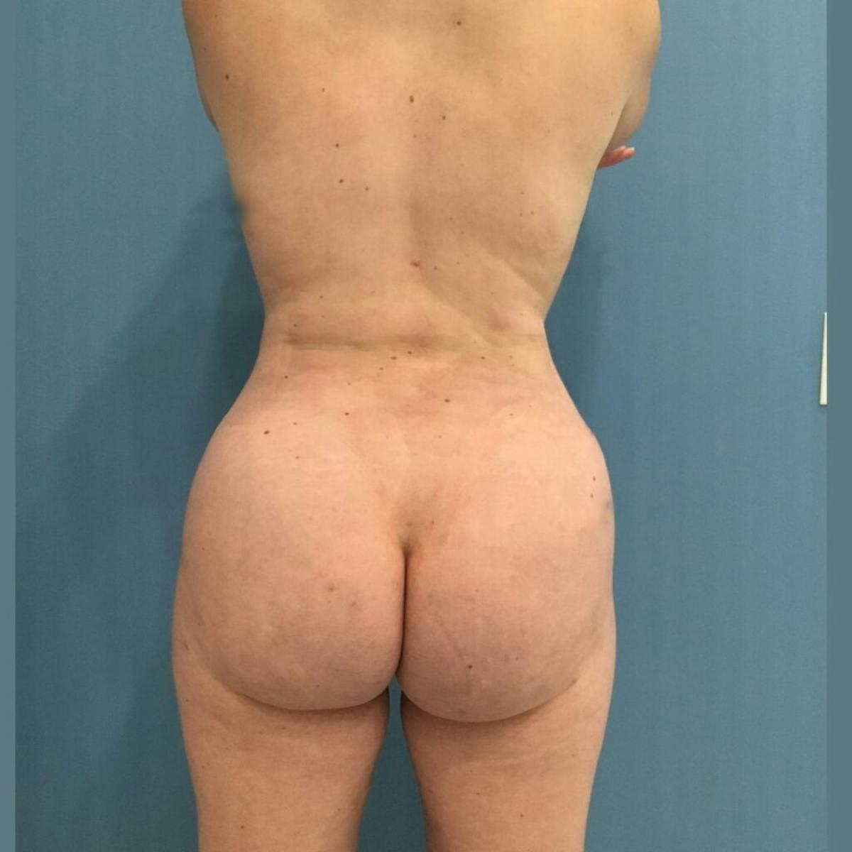 Basu Plastic Surgery bbl after — Houston, TX