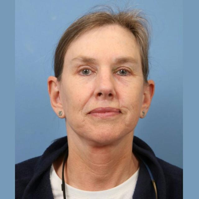 Neck Lift after at Basu Plastic Surgery in Houston, TX