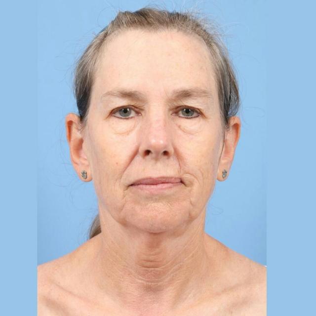 Neck Lift before at Basu Plastic Surgery in Houston, TX