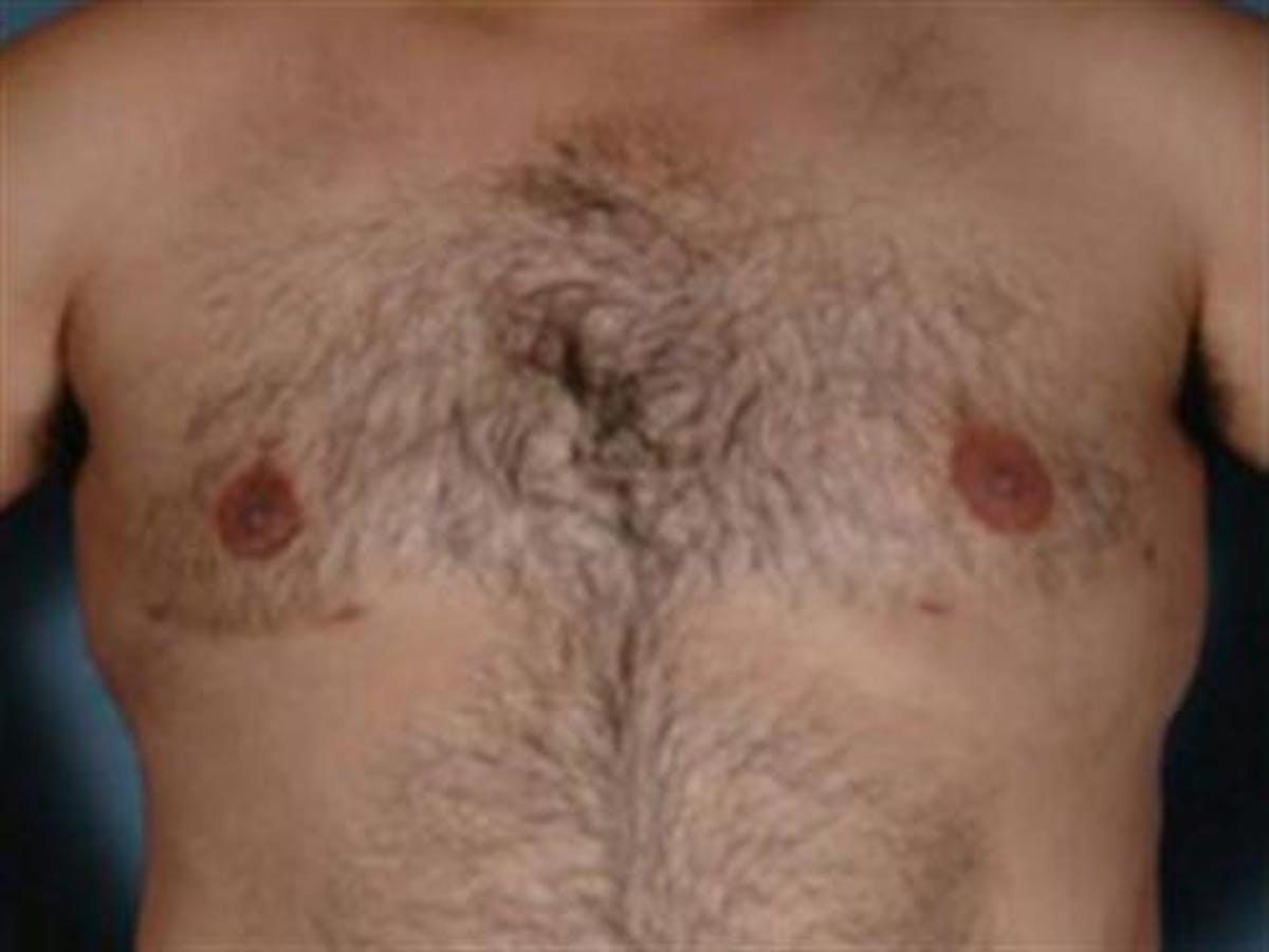 Basu Plastic Surgery gynecomastia after — Houston, TX