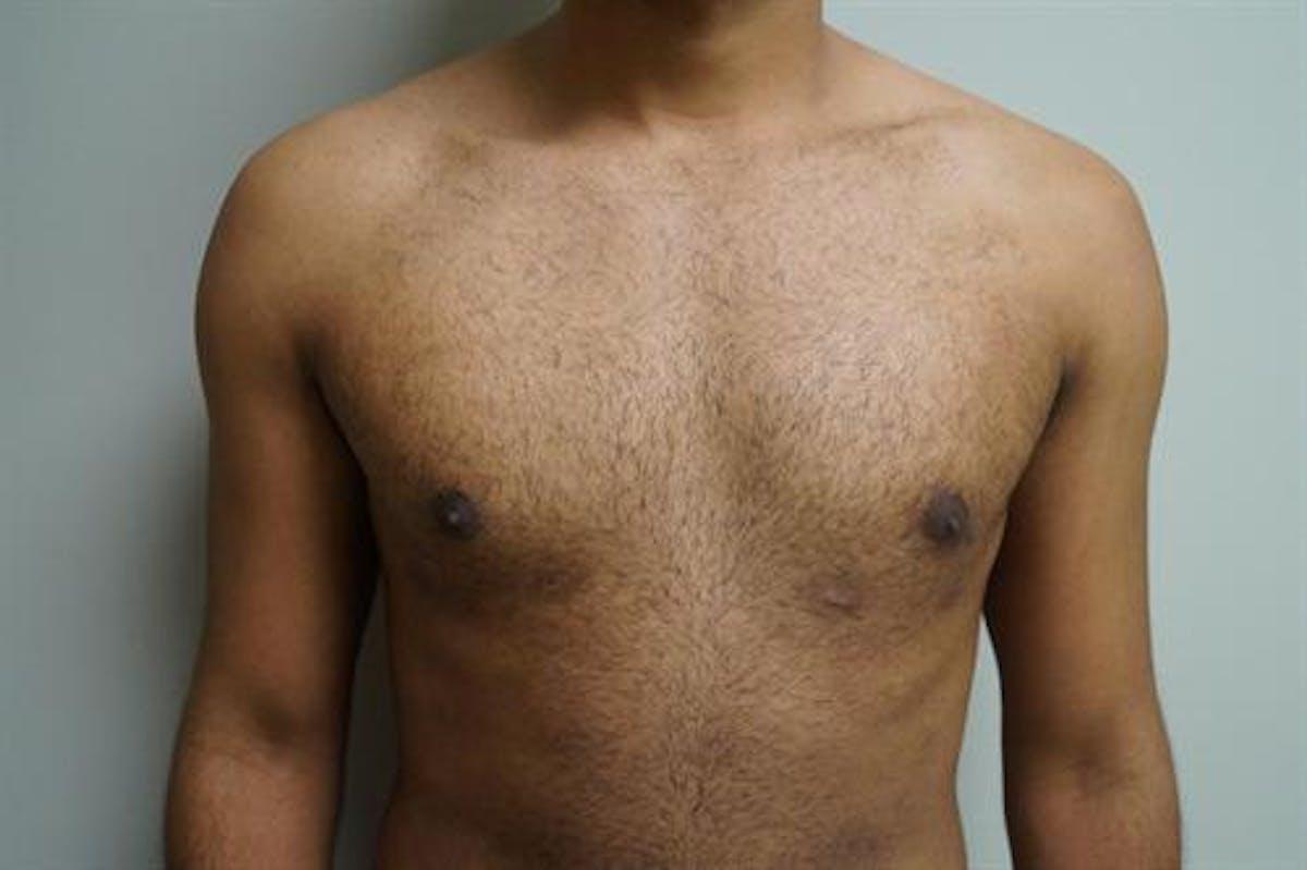 Basu Plastic Surgery gynecomastia after — Houston, TX