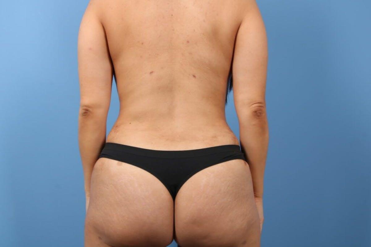 Basu Plastic Surgery bbl after — Houston, TX