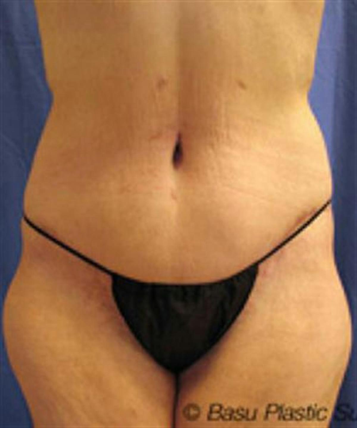 Basu Plastic Surgery body lift after — Houston, TX