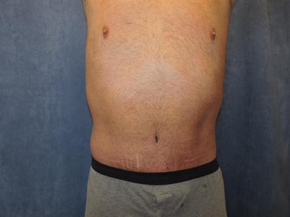 Basu Plastic Surgery body lift after — Houston, TX