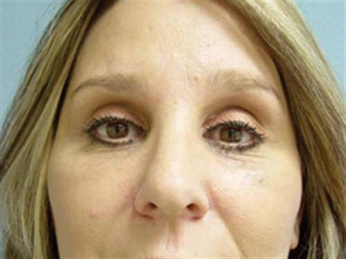 Basu Plastic Surgery blepharoplasty after — Houston, TX