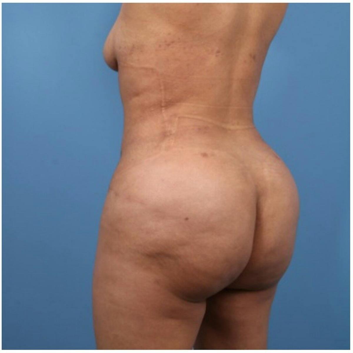 Basu Plastic Surgery bbl after — Houston, TX