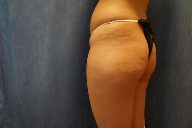 Brazilian Butt Lift before at Basu Plastic Surgery in Houston, TX