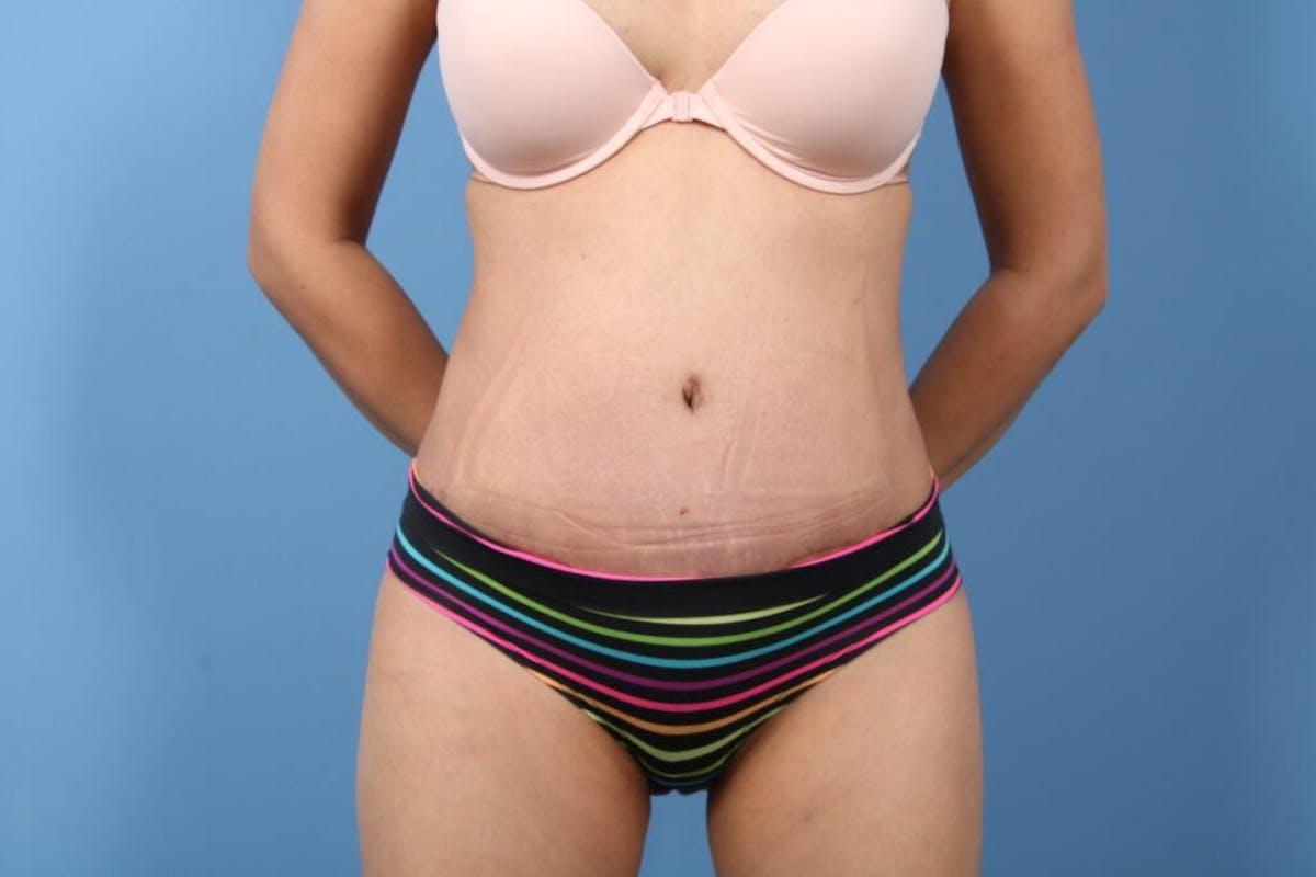 Basu Plastic Surgery tummy tuck after — Houston, TX