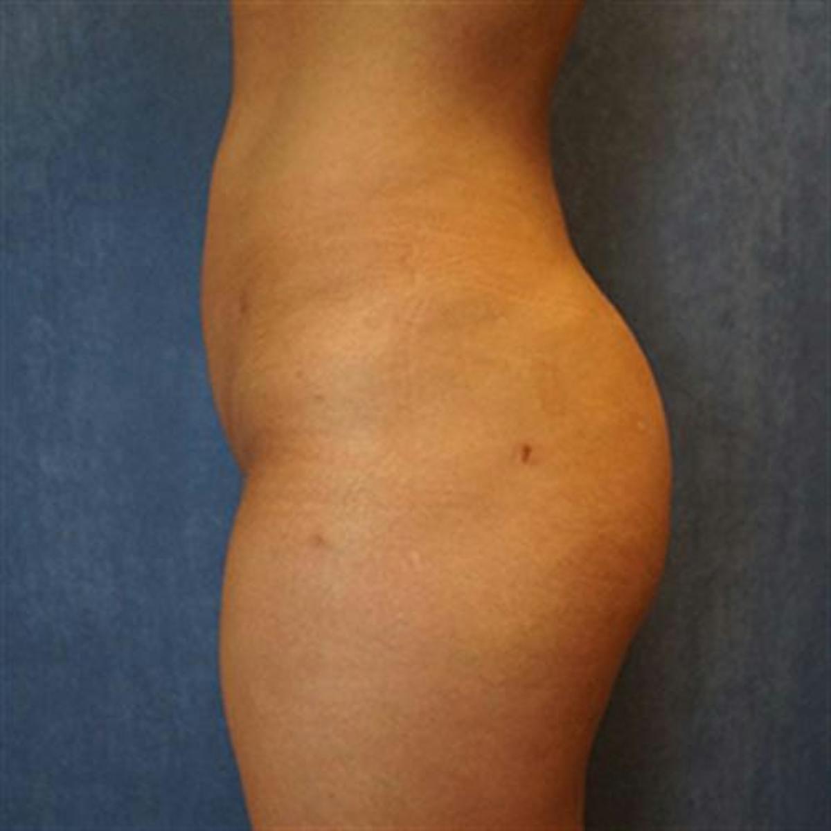 Basu Plastic Surgery bbl after — Houston, TX