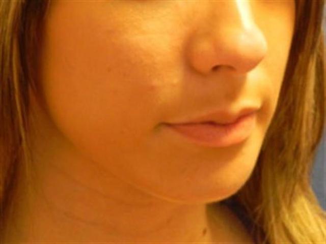 Chin Implant after at Basu Plastic Surgery in Houston, TX