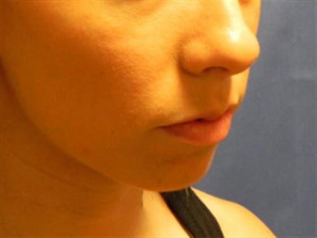 Chin Implant before at Basu Plastic Surgery in Houston, TX