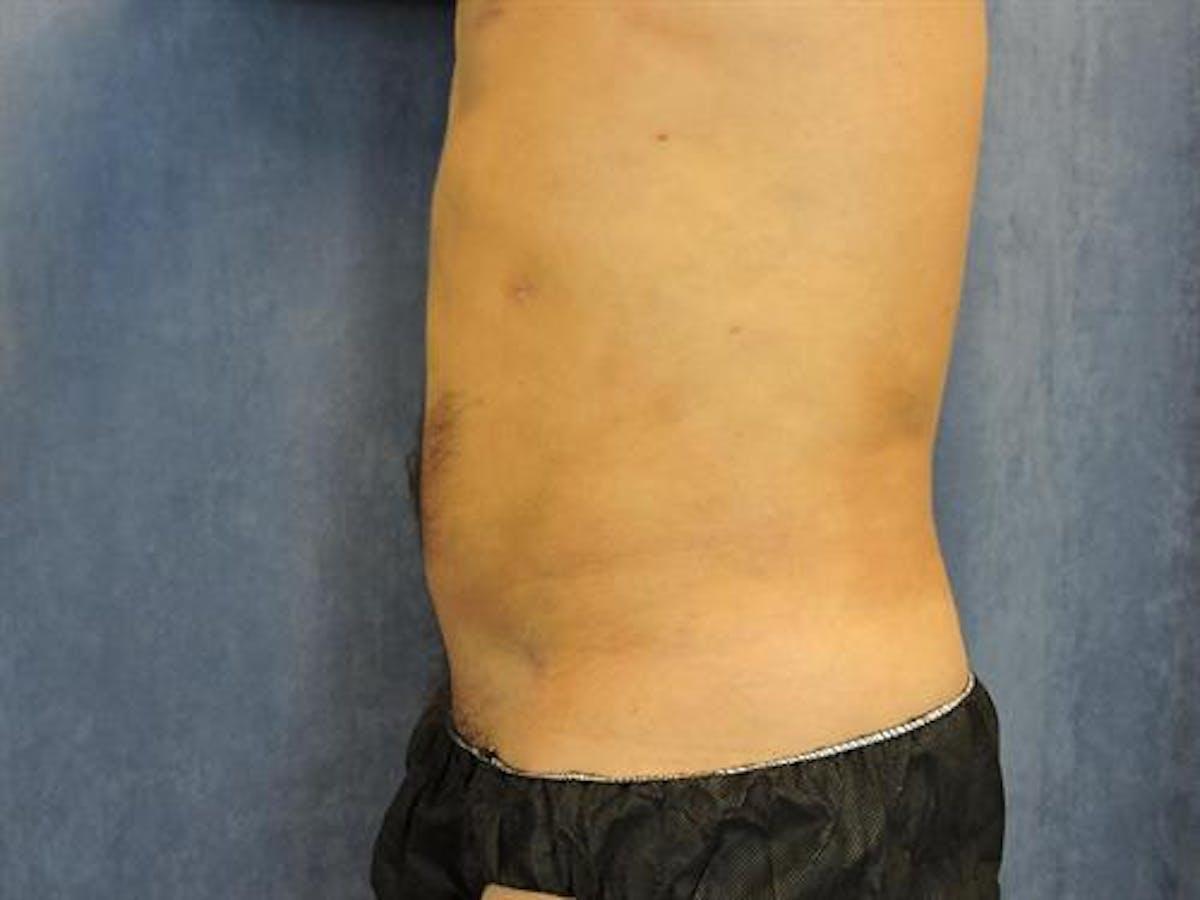 Basu Plastic Surgery liposuction after — Houston, TX